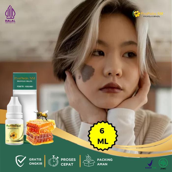 Penghilang Tanda Lahir, Tanda Lahir Hitam Coklat, Penghilang Tanda Lahir Di Wajah