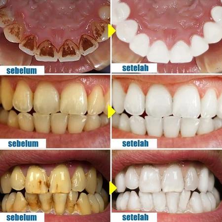 PEMBERSIH KARANG GIGI PENGHILANG KARANG GIGI MEMBANDEL ALAT PEMBERSIH KARANG GIGI PEMUTIH GIGI