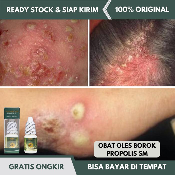 Obat Oles Borok, Obat Borok Di Kaki, Borok Di Kepala, Borok Bernanah