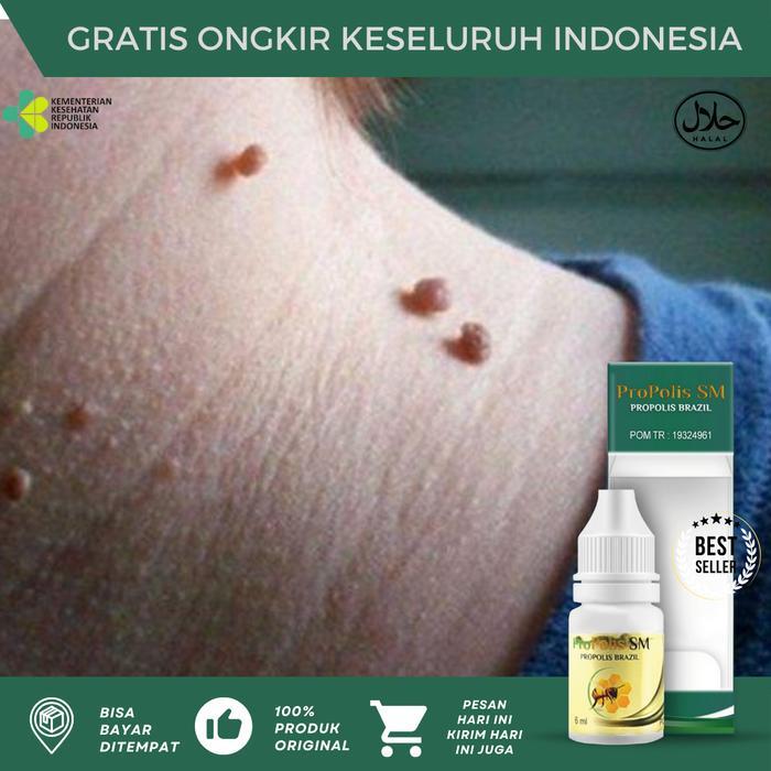 Kutil Papiloma Di Leher, Perontok Kutil Dileher, Penghilang Papiloma, Papiloma Di Wajah, Pengempis