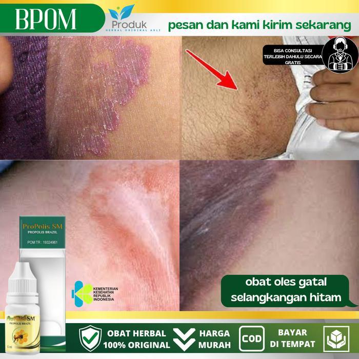 Propolis Sm Untuk Menghilangkan Gatal Di Area Selangkangan Terbaru !!!