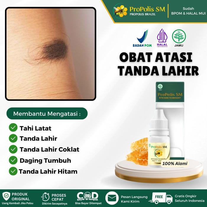 Propolis SM - Obat Oles Penghilang Tanda Lahir, Tanda Lahir Hitam, Tanda Lahir Coklat, Tanda Lahir