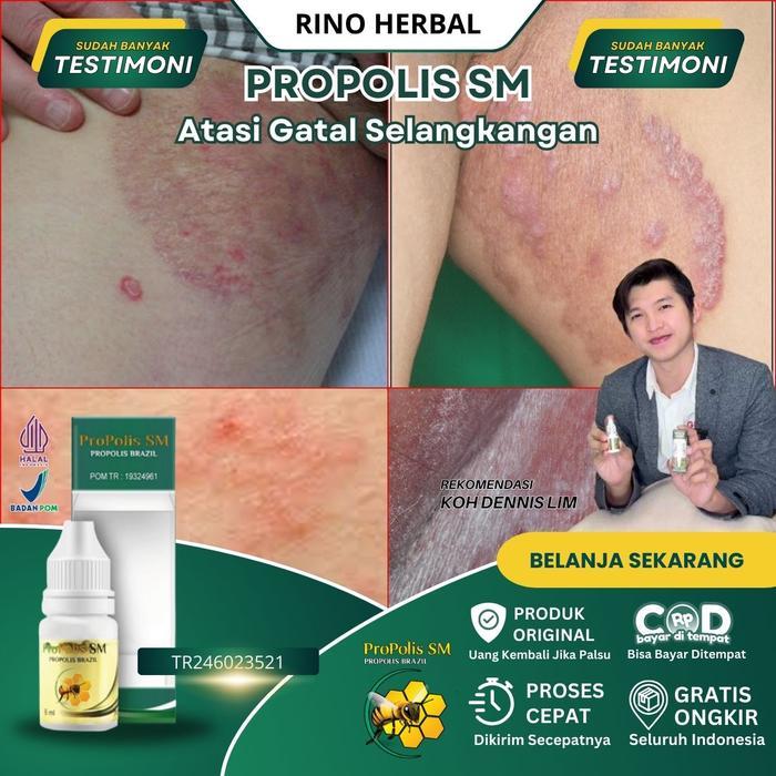 Salep Selangkangan Gatal Hitam, Selangkangan Hitam Dan Gatal, Selangkang Lecet, Jamur Selangkangan,