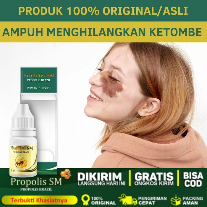 Propolis SM - Penghilang Tanda Lahir Coklatn Penghilang Tompel, Tanda Lahir Merah Hitam Coklat Anak