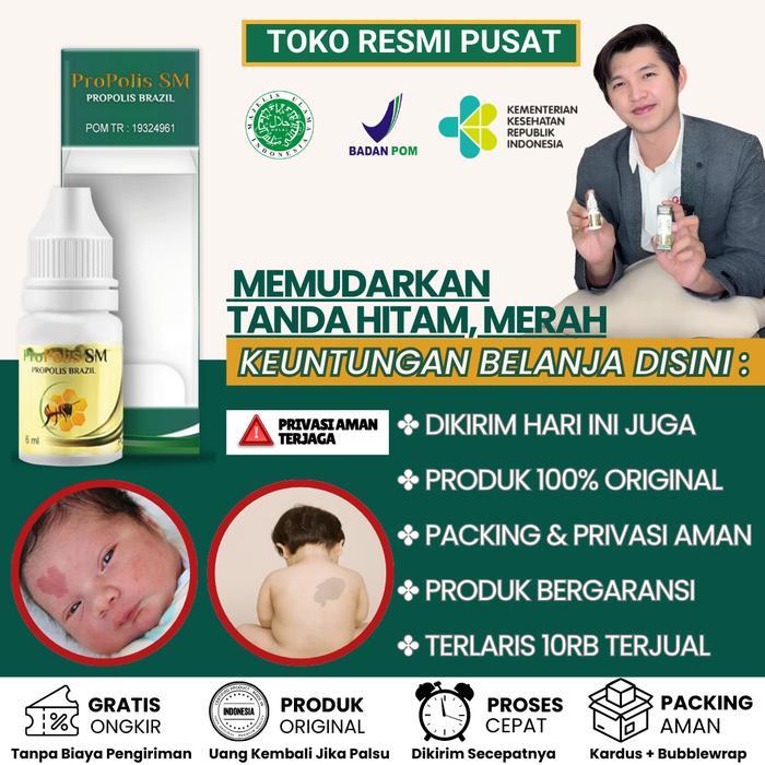 Propolis SM Krim / Salep Penghilang Tanda Lahir Hitam, Coklat, Merah Menonjol