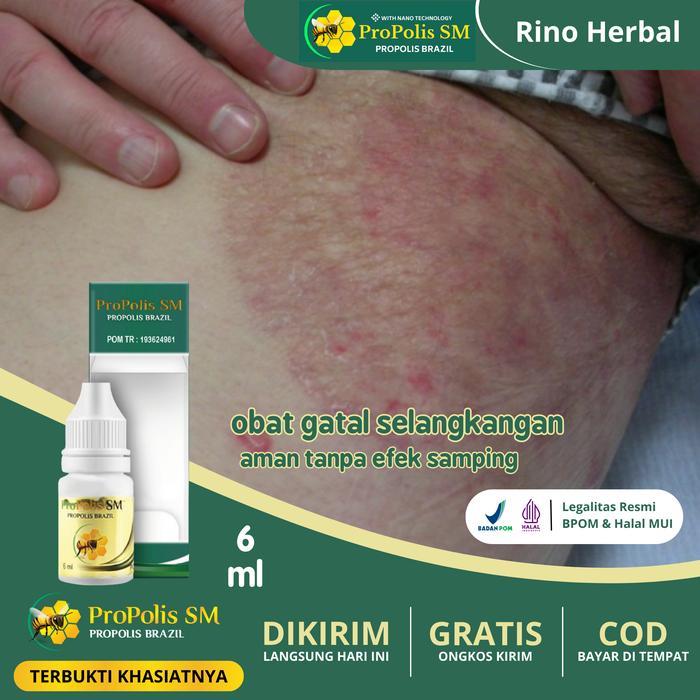 Propolis Sm Herbal Selangkangan Hitam, Gatal Selangkangan, Gatal Kelamin, Gatal Pada Kulit Eksim