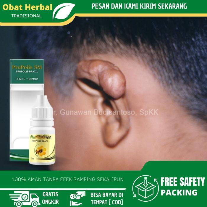 Ready - Propolis SM Solusi Untuk Penghilang Benjolan Di Telinga, Keloid Di Telinga, Keloid Bekas