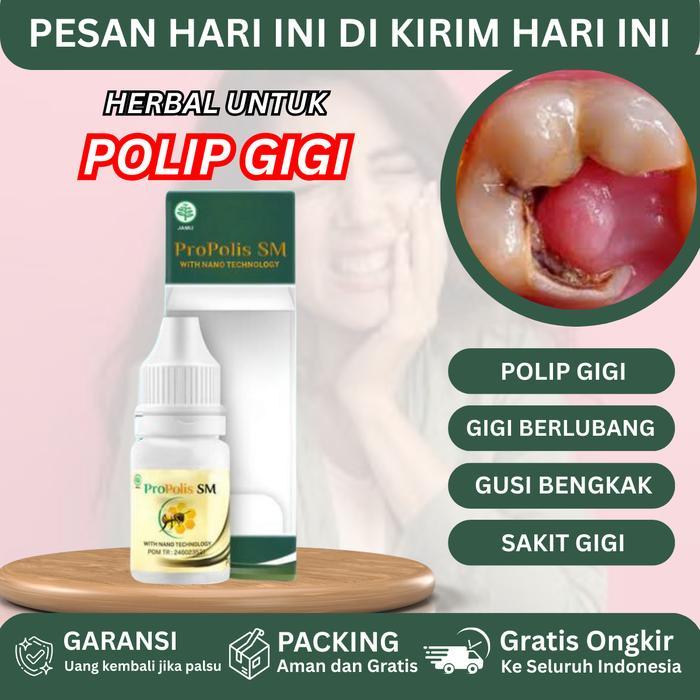 Propolis SM Untuk Polip Pulpa, Polip Gigi Di Gusi, Polip Gigi, Polip Gusi, Gusi Bengkak, Abses Gusi,