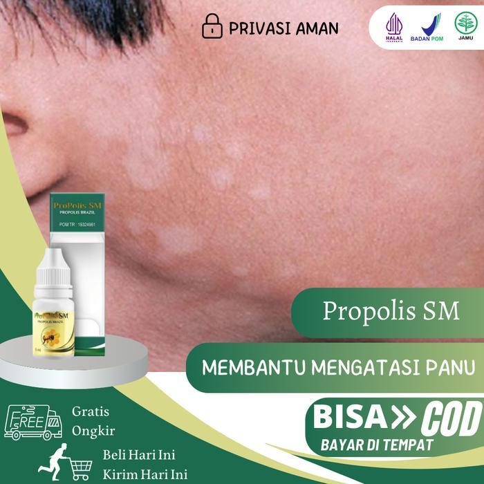 Propolis Sm - Salep Panu Di Wajah, Panu Di Badan, Panu Di Tangan, Hapuran, Balas Bogo, Bercak Putih,