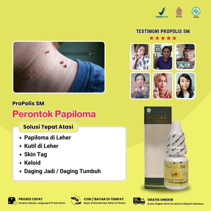 Propolis Sm Perontok Kutil Papiloma Di Leher Dan Wajah Perawatan Berjerawat Hitam Muka Facial