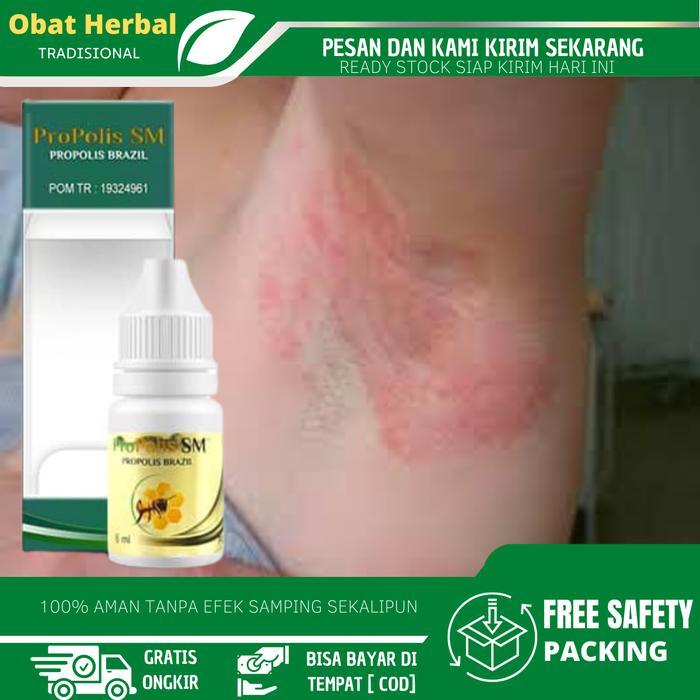 Propolis Sm Cairan Oles Untuk Iritasi Ketiak, Ketiak Ruam Merh, Gatal Merah Pada Ketiak, Lupatan