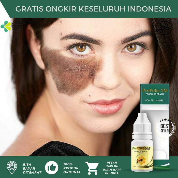 Penghilang Tanda Lahir, Tanda Lahir Hitam Coklat, Penghilang Tanda Lahir Di Wajah, Penghilang