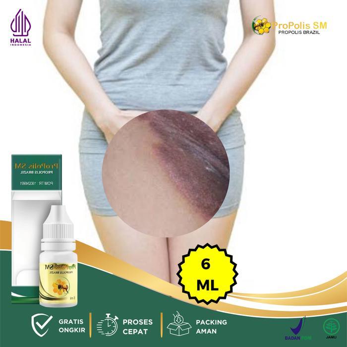 Salep Jamur Selangkangan Lecet Sela Paha - Obat Gatal Hitam di Area Kelamin