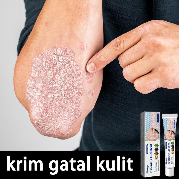 SALE krim gatal kulit Penyakit Kulit Gatal gatal eksim TERMURAH