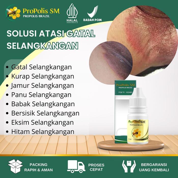 Selangkangan Hitam Dan Gatal, Selangkangan Berjamur, Salep Jamur Selangkangan Gatal, Exim