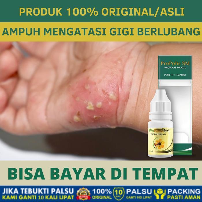 Salep Scabies, Kudis, Gatal Bernanah, Infeksi Kulit