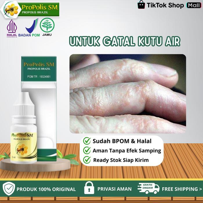 Propolis Sm - Untuk Gatal Kutu Air Gatal Berair Di Jari Tangan Dan Kaki, Gatal Berair Di Sela Jari,