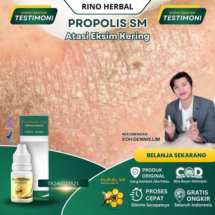 Obat Eksim Kering Menahun, Obat Eksim Basah dan Kering Menahun, Obat Eksim Menahun, Eksim Basah,