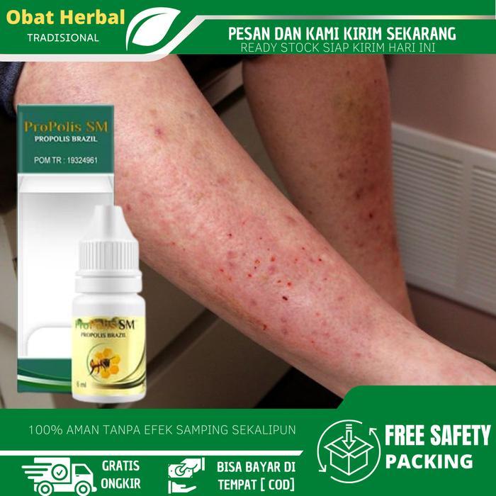 Salep Untuk Alergi Semen, Ruam Kemerahan Di Kaki/ Tangan, Gatal Akibat Alergi Semen, Dermatitis