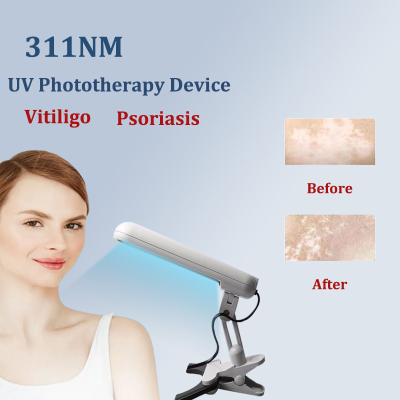 UVB 311NM Narrowband Ultraviolet Lamp Phototherapy Instrument Treatment Vitiligo Lamp for Psoriasis