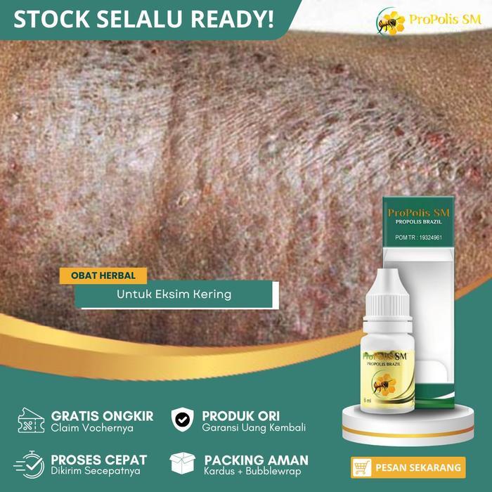 Eksim Kering, Eksim Basah, Gatal Eksim, Exim, Eksim, Exsim, Eksim Menahun, Salep Eksim, Gatal Kulit