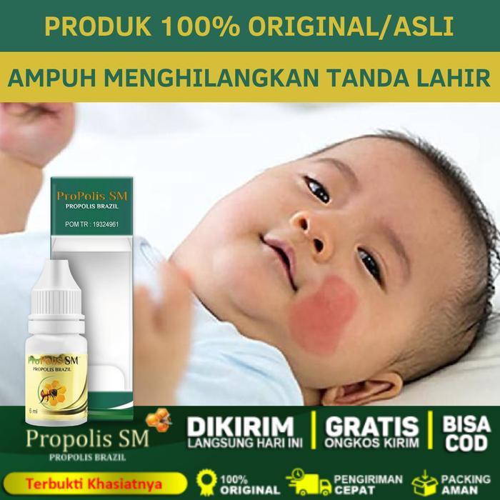 Penghilang Tanda Lahir Merah Aman Untuk Bayi, Tanda Lahir Hitam, Coklat Di Wajah, Hemangioma, Tanda