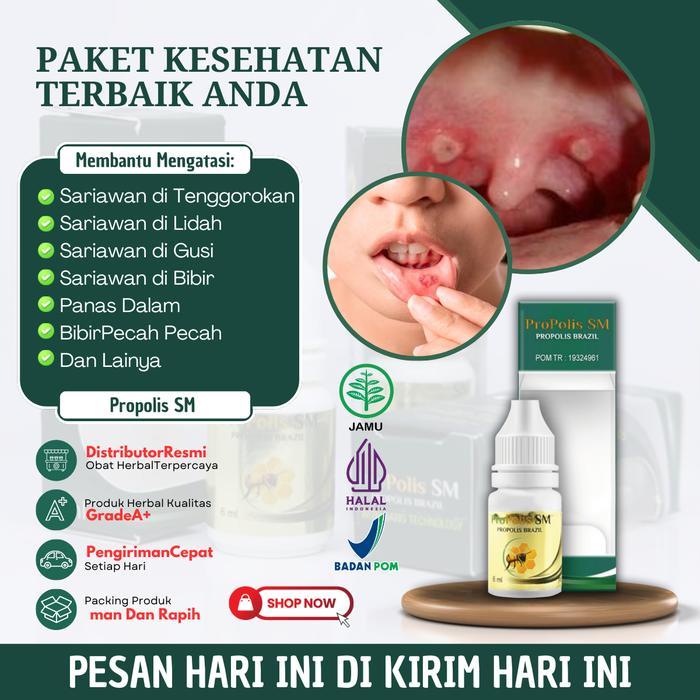 Propolis SM Solusi Untuk Mengatasi Sariawan Parah, Sariawan di Tenggorokan, Sariawan di Lidah,
