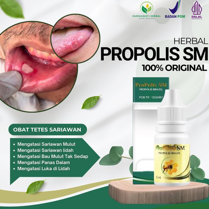 Obat Sariawan Mulut, Sariawan Lidah, Sariawan Pada Anak dan Dewasa Bau Mulut Propolis SM
