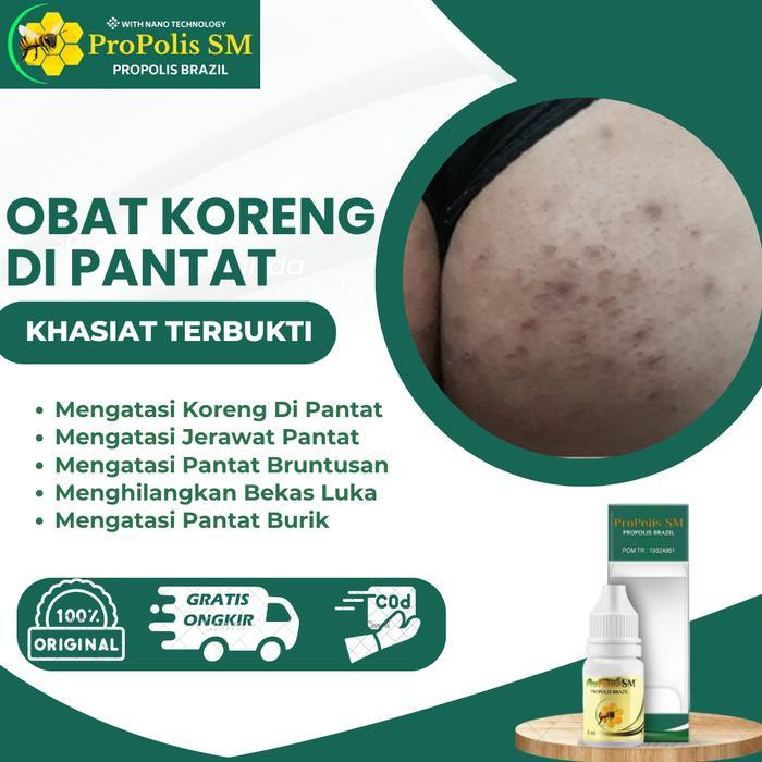 Penghilang Koreng Di Pantat, Jerawat Pantat, Bruntusan Pantat, Bekas Bisul Herbal Propolis Sm