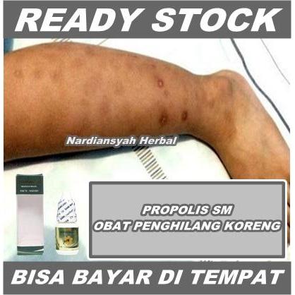 Obat Bekas Korengan, Salep Penghilang Bekas Luka Koreng Lama Di Kaki Terbaru 