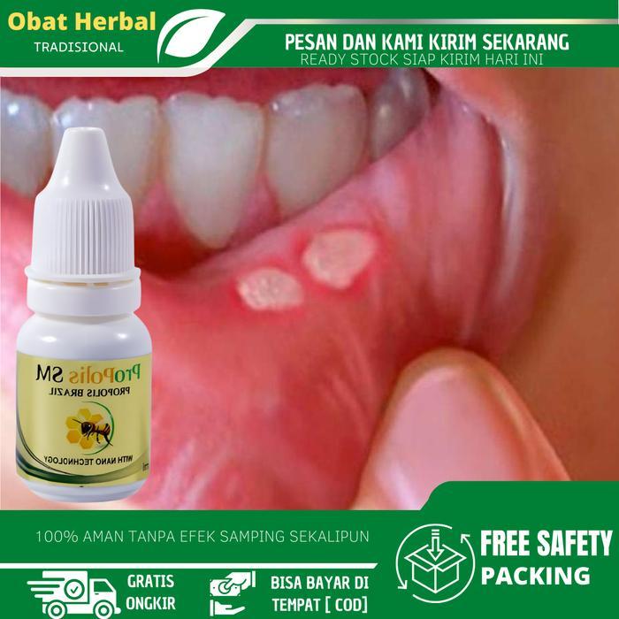 Cairan Oles Untuk Menghilangkan Sariawan, Sariawan Mulut, Sariawan Di Lidah, Sariawan di Bibir,