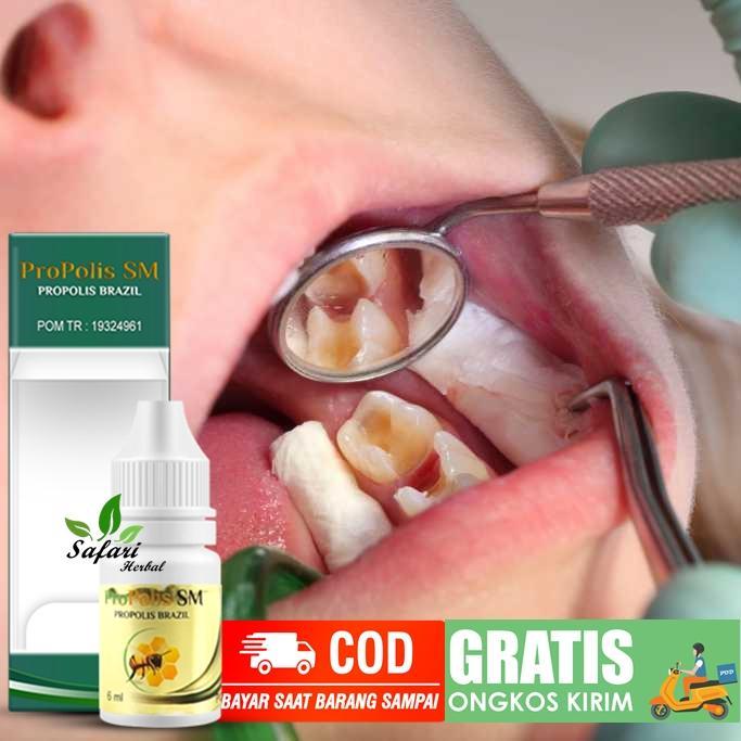 Obat Kumur Penghancur Gigi Berlubang, Perontok Karang Gigi-PROPOLIS SM