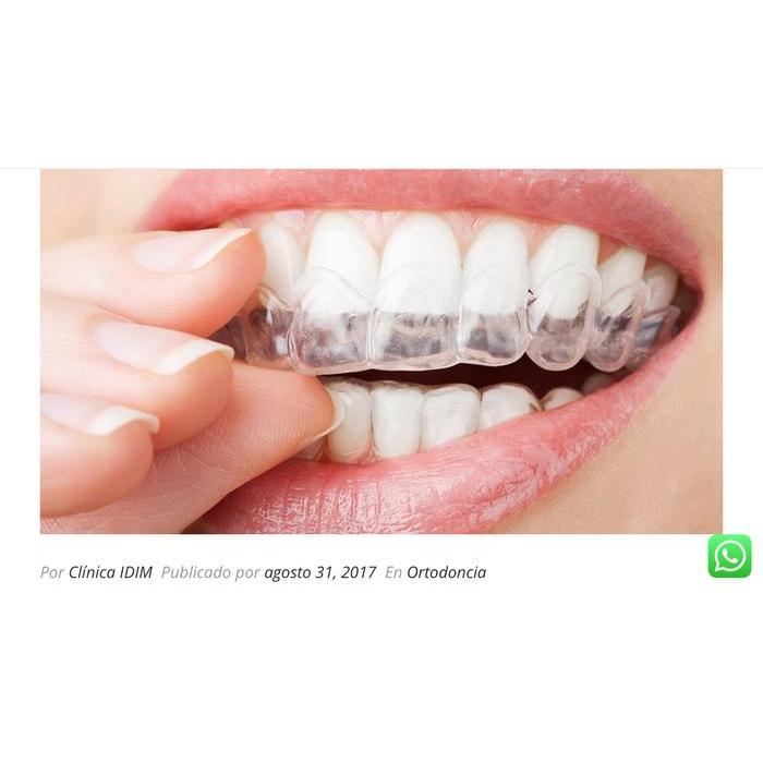 Orthodontik Retainer Vacum Bening / Mencegah Gigi Berantakan #Gratisongkir