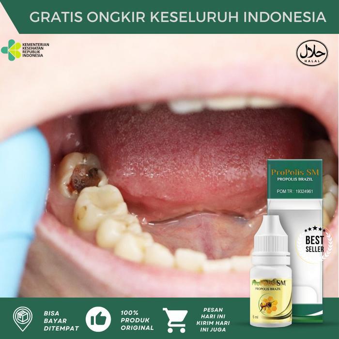Promo Propolis Sm Gigi Rusak, Gigi Bolong, Gigi Hitam, Ulat Gigi, Perontok Gigi Berlubang, Gigi