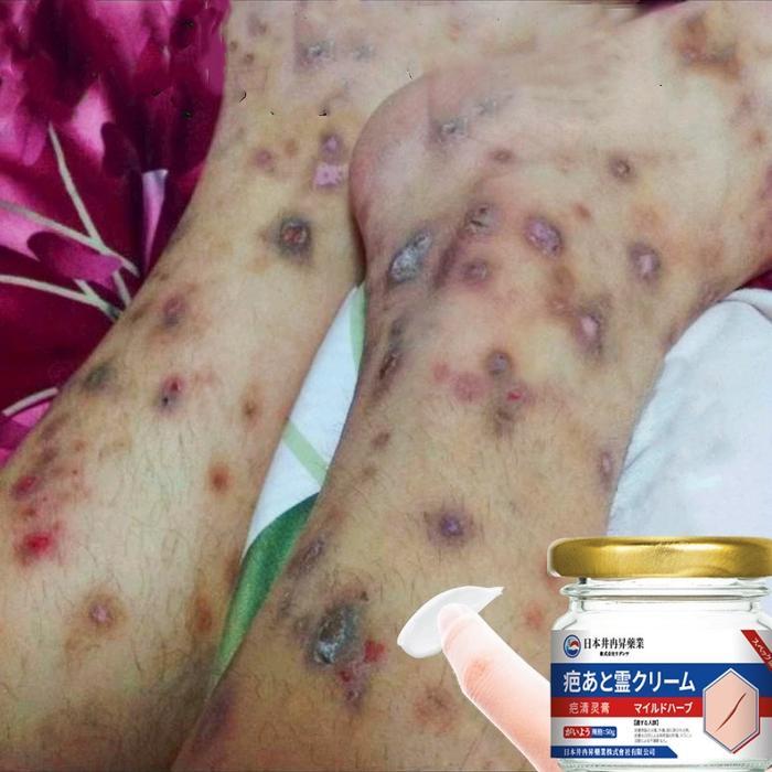 Penghilang Bekas Luka Hitam Koreng Penghilang Bekas Luka Di Kaki Bekas Luka Bakar Bekas Lama Keloid