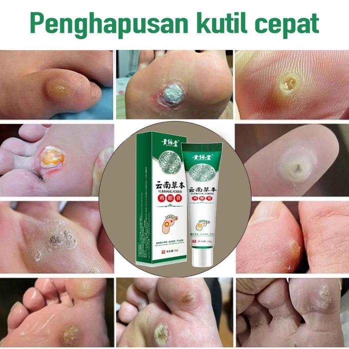 obat mata ikan Obat Kutil Kapalan Mata Ikan Kaki 20g Kaki Ampuh Plester Penghilang Kutil Kapalan
