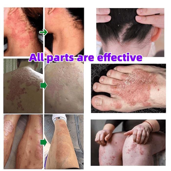 Sabun gatal kulit ampuh Sabun eksim Menghilangkan Eksim Psoriasis Kurap dan infeksi jamur