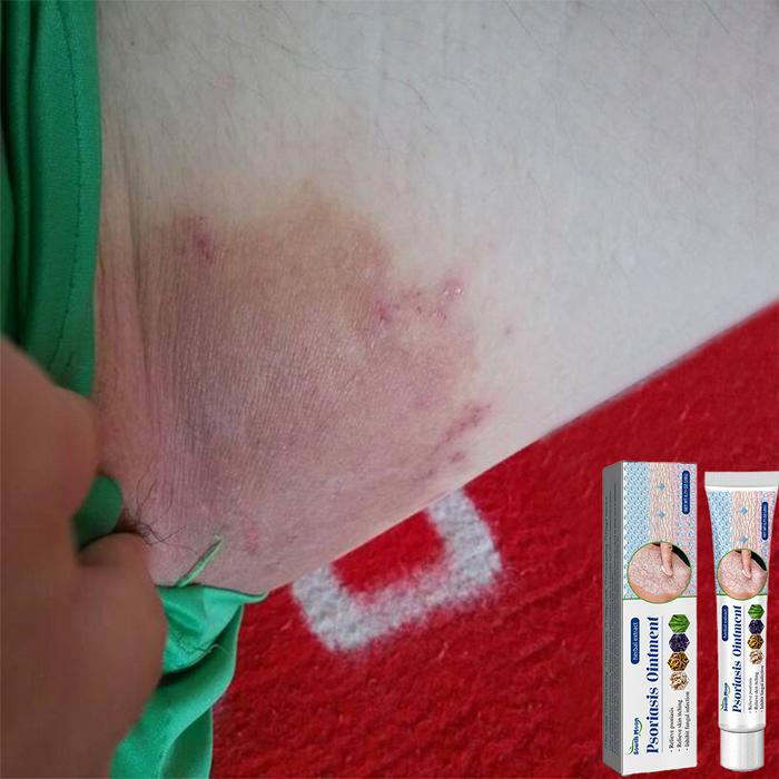 Mujarab Krim Gatal Kulit Penyakit Kulit Gatal Seluruh Badan Murah