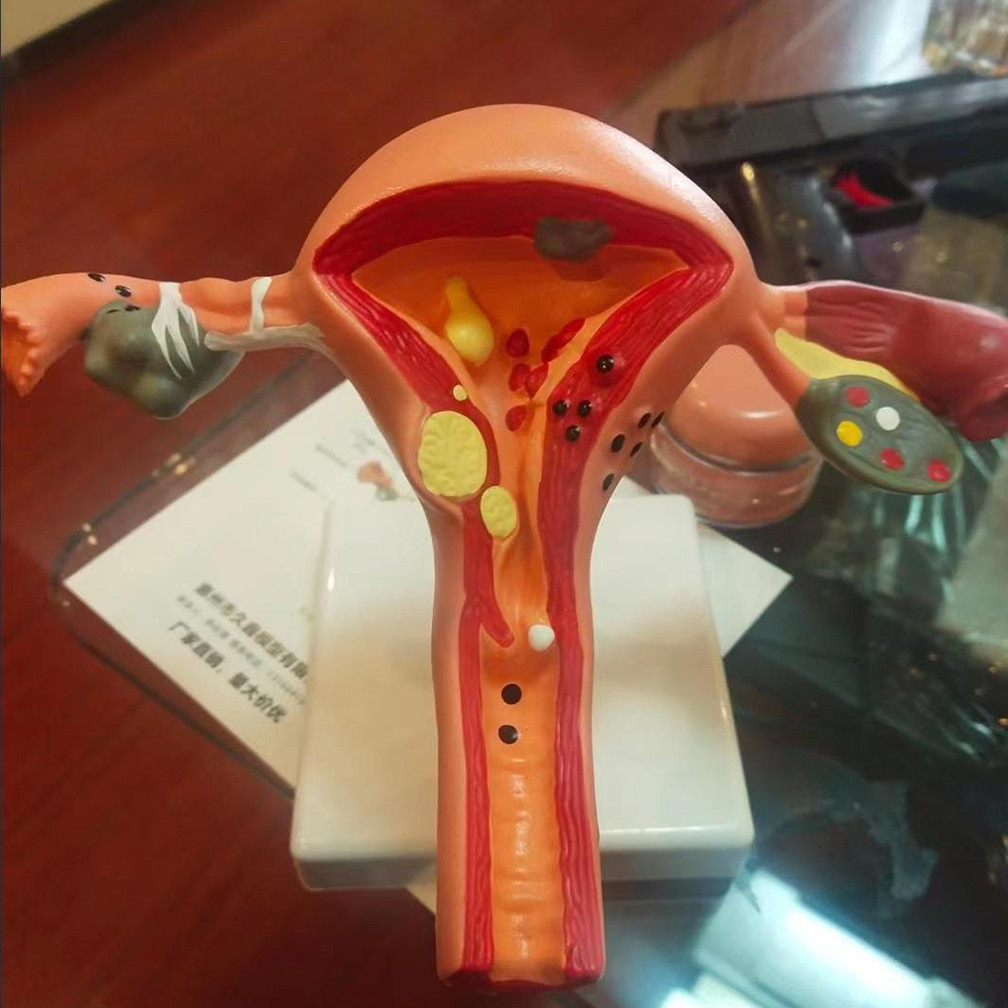 Promo Medical Props Model Human Female Pathological Uterus Ovary Model Anatomical Disease Pathology 