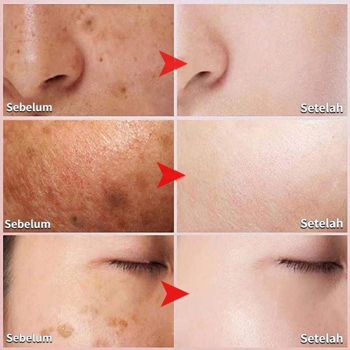 Krim penghilang flek hitam cream flek hitam membandel salep flek hitam membandel 20g menghilangkan