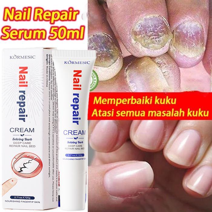 Krim perbaikan kuku, salep antijamur kuku, jamur kuku kaki, infeksi jamur kuku tangan, kuku tumbuh