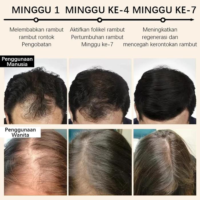 Shampo penumbuh rambut minoxidil 5% Shampo rambut rontok Mencegah Shampoo Penumbuh Rambut Cepat
