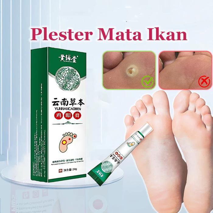 Obat Mata Ikan Pada Telapak Kaki, Perontok Mata Ikan di Telapak Kaki & Tangan, Mata Ikan Di Kaki,
