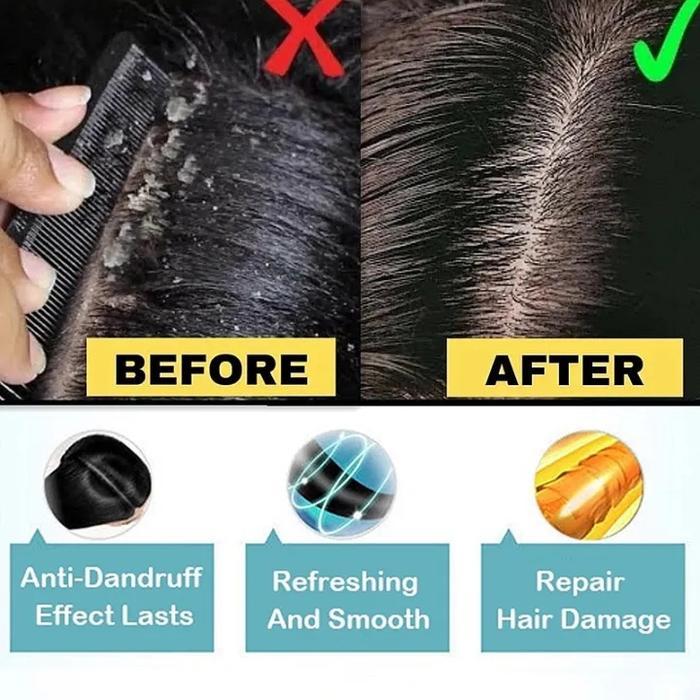 OBAT KETOMBE PARAH Scalp Itching Anti itching cream Obat Psoriasis di Kepala Eksim Kulit kepala