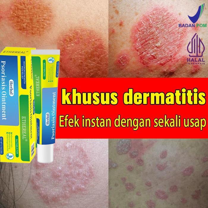 [Obat Gatal Terkuat]Obat gatal gatal kulit,Salep Gatal Psoriasis,Kaya Obat Herbal China,Esens