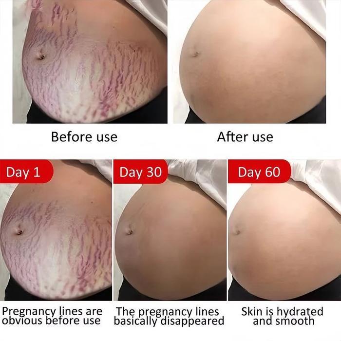 Stretch mark cream stretch mark paling ampuh 30ml rintik stretch mark cream Krim Perawatan