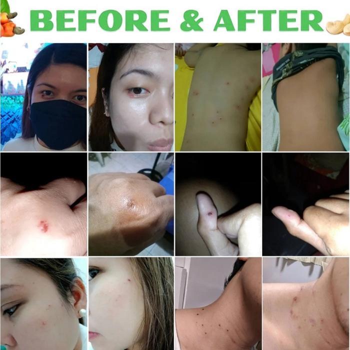 obat mata ikan Obat Kutil Kapalan Mata Ikan Kaki 20g Kaki Ampuh Plester Penghilang Kutil Kapalan
