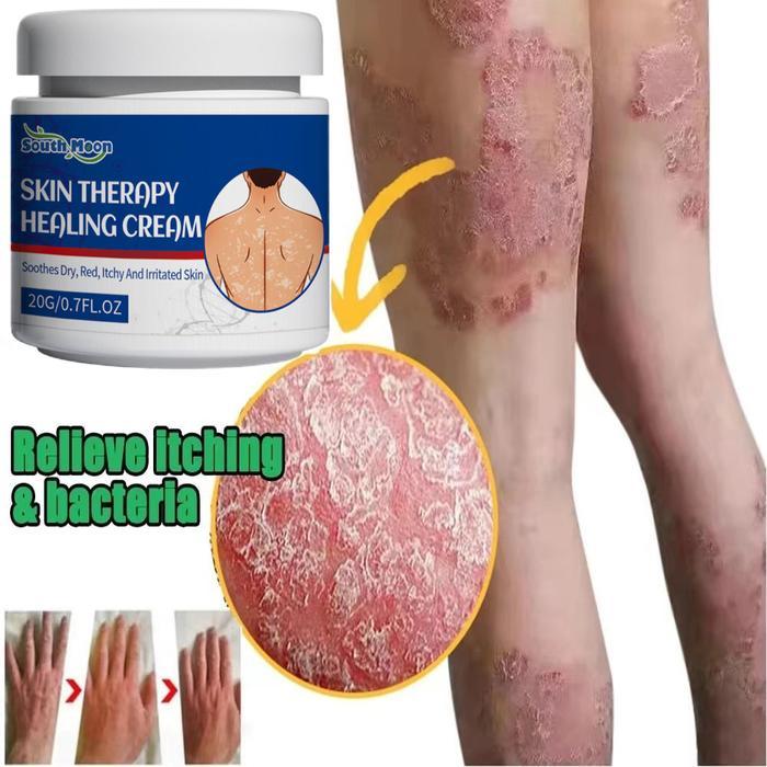 Salep Gatel2 Paling Ampuh / Obat Gatel2 Kulit Ampuh / Obat Gatal / Obat Gatal Gatal Pada Kulit /