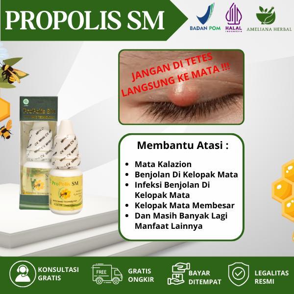 Propolis Sm - Untuk Mata Kalazion Benjolan Di Kelopak Mata Infeksi Benjolan Di Kelopak Mata Kelopak