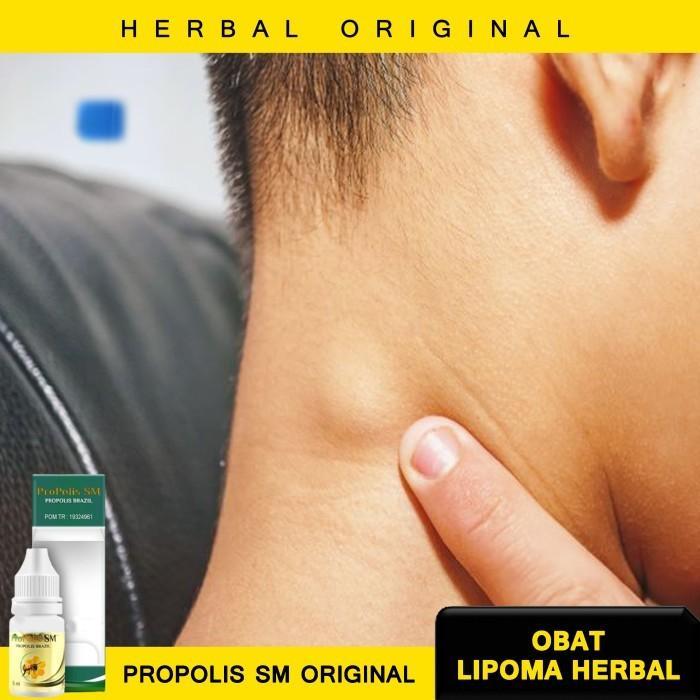 Terlaris COD - Obat Oles Herbal Penghancur Benjolan Tiroid Lipoma Gindok Halal